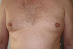 -> Fettabsaugung an der Brust