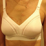  -> Brustvergrößerung mit  Implantaten