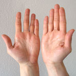  -> Übermäßiges Schwitzen  an den Händen und  den Fußsohlen